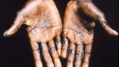 Latest company news about การระบาดของโรค Monkeypox ก่อให้เกิด 'ความเสี่ยงปานกลาง' ต่อสุขภาพของประชาชนทั่วโลก WHO กล่าว